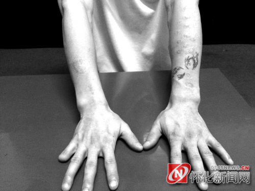 自残是毒虫们宣泄情感时最常见的身体语言之一。图中这位吸毒(戒毒)者,手臂上的瘢痕全是自己用烟头所烫。狂躁之余,他甚至将小指头剁掉一节。 (杨林斌 摄)